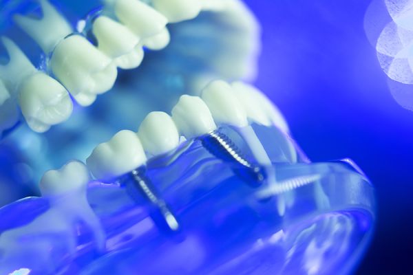 3d image of a jaw showing multiple teeth implants