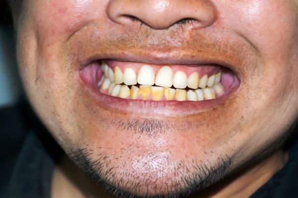 mans teeth showing discolouration, most probably from smoking